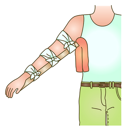 Image of splint on arm extending above the elbow and below the wrist